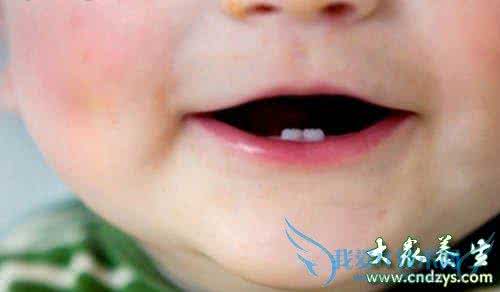 牙釉质发育不良 牙釉质发育不良 儿童牙釉质发育不良怎么治疗？