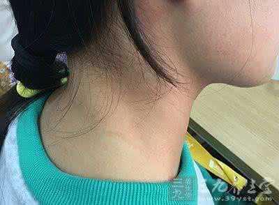 脖子上长褐色颗粒物 脖子上长这物当心不能怀孕