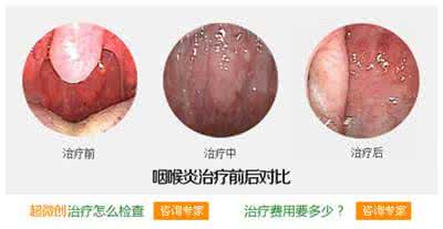 咽喉炎长期不好的原因 咽喉炎长期不好的原因 咽喉炎一直不好的原因？