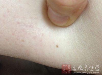 绝经后出血患癌几率 女人这一时期患癌几率翻倍