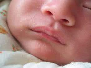 小儿皮炎湿疹的治疗 小儿皮炎湿疹是什么原因导致的呢？