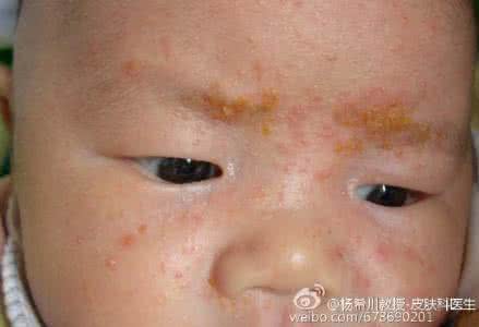 皮肤老年斑怎么办 郭力话健康：青春痘、老年斑、婴儿湿疹、皮肤干……做个面膜儿来应对！