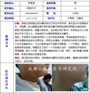 说明方式是什么 说明方式是什么 白癜风治疗方式说明