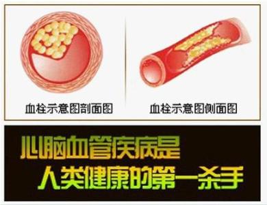 心脑血管疾病能治好吗 心腦血管疾病的防治