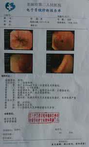 糜烂性胃炎中药处方 糜烂性胃炎中药处方 糜烂性胃炎中药处方有哪些