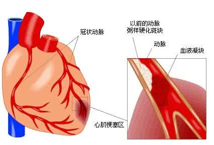 心肌梗塞疼痛部位 心肌梗塞 疼痛部位 心肌梗塞疼痛怎么办？