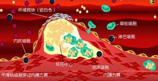 动脉粥样硬化防治 动脉粥样硬化 应该从儿童期开始防起