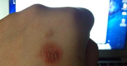 疤痕体质玛恩皮肤 疤痕体质 疤痕皮肤