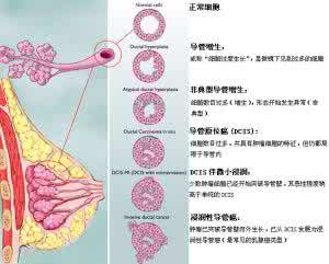 乳腺癌的治疗原则 乳腺癌分期 乳腺癌分期治疗原则介绍