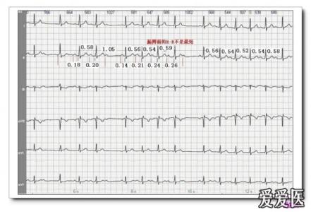 山羊老师心电图讲座 山羊老师课程常见心电图诊断知识讲座第十五讲——房性心律失常