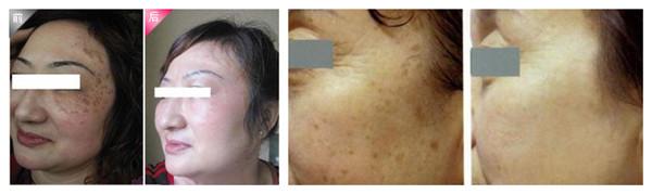 老年斑激光后注意事项 老年斑注意事项 老年斑患者的注意事项