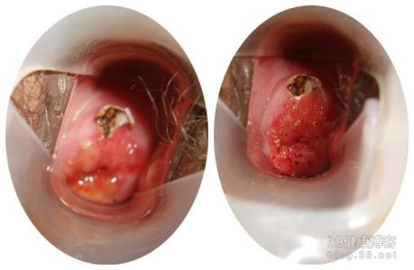 宫颈息肉最佳治疗方法 宫颈息肉中药治疗 宫颈息肉中药治疗方法