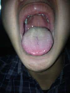 酒精肝是怎么回事 口臭怎么回事 口臭或为酒精肝的预兆