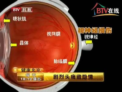 虹膜炎的健康宣教 《健康北京》剧烈头痛+虹膜炎-青光眼