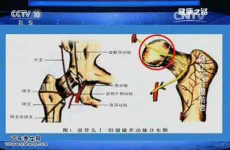 健康之路膝关节疼痛 20160120健康之路视频和笔记:周一新,关节老化,股骨头坏死,痛风