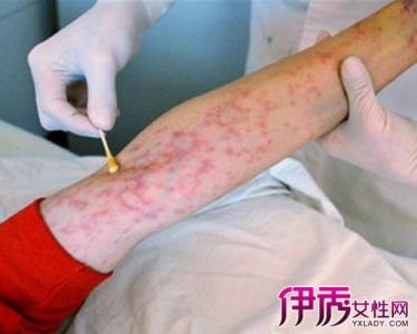 艾滋病潜伏期 艾滋病 艾滋病潜伏期