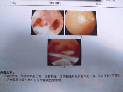 做流产时可以上环吗 做流产时可以上环吗 刚流产能上环吗？