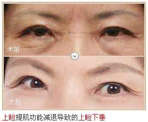 上睑下垂如何治疗 上睑下垂 如何治疗上睑下垂