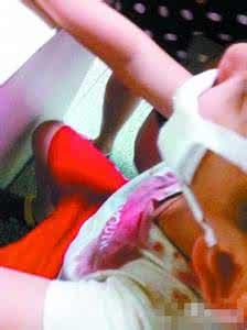 脸部缝针疤痕 男孩脸部炸伤缝了38针，这东西你家也放冰箱，家有小孩必须警惕!