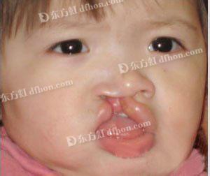 兔唇整形 兔唇 兔唇整形