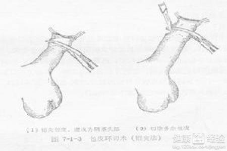 阴茎癌早期会有啥症状 阴茎癌检查主要有哪些项目