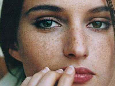 去雀斑的正确方法 雀斑怎么去?正确去雀斑的方法