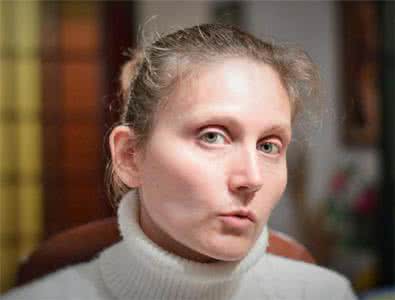 脱发补充维生素 脱发补充维生素 脱发需补充维生素