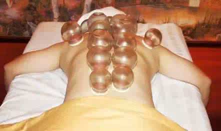 因为拔火罐染上艾滋病 拔上一罐,病去一半!为什么要在背部拔罐?