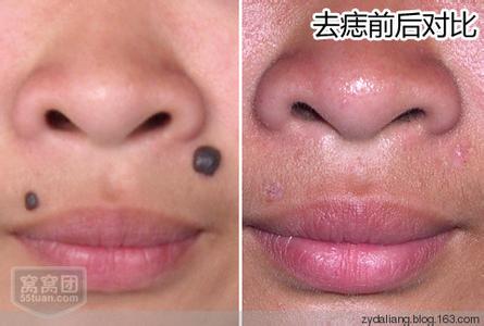 去黑痣最有效的方法 去痣的土方法