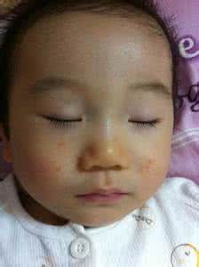 2岁儿童脸上湿疹怎么办 2岁宝宝湿疹怎么办