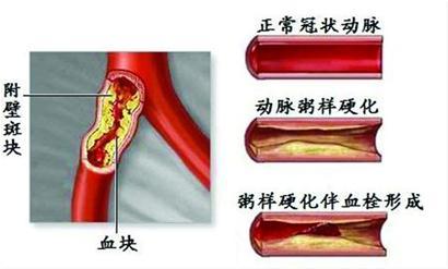 老中医不花钱减肥秘方 国宝秘方:高血压引起之血管硬化根治不花钱
