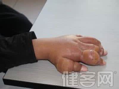 痛风代谢途径的分类 痛风不仅仅是痛 应及早排查防治代谢障碍