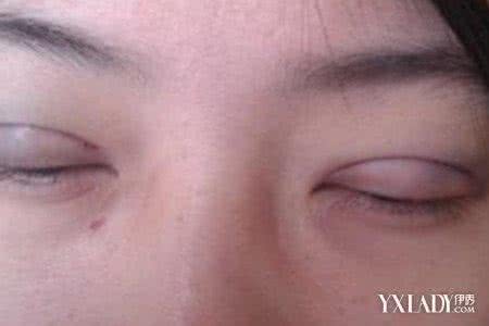 去除脂肪粒的小偏方 怎样去除脂肪粒 怎样快速去除脂肪粒