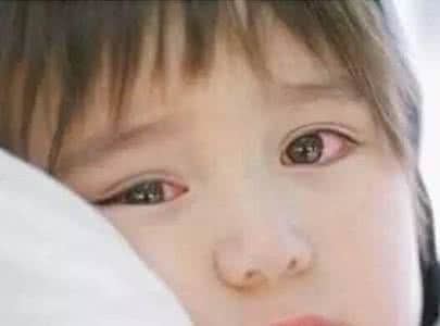 儿童得红眼病怎么办 宝宝得了红眼病怎么办
