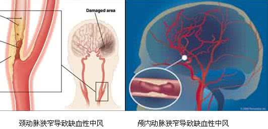 脑血管支架手术费用 脑血管支架能坚持几年 血管变硬了怎么办? 每天坚持6步血管软下来