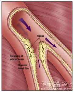 动脉血管硬化的治疗 动脉血管硬化 动脉血管硬化的检查
