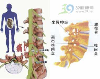 腰椎间盘突出症康复 中药治疗腰椎间盘突出症临床用药规律的聚类分析