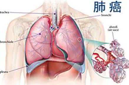 肺癌发病原因 肺癌早期症状 肺癌的发病原因