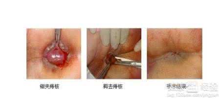 内痔疮的最佳治疗方法 痔疮 如何选择痔疮的治疗方法
