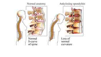 什么是强制性脊椎炎 强制性脊椎炎 什么是强制性脊椎炎