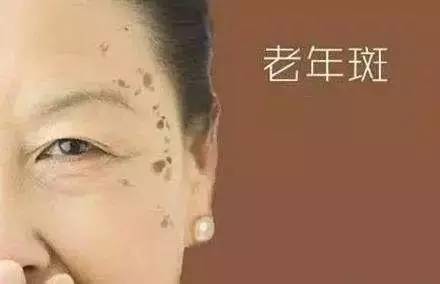 为什么牙膏能去老年斑 牙膏,原来是老年斑的克星!可惜没有几个人知道!