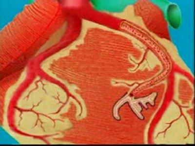 心肌梗死最佳抢救时间 心肌梗死犯病时