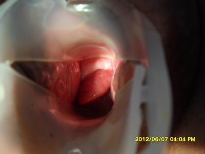 为什么会长宫颈息肉 宫颈口长息肉 总是长宫颈息肉怎么办?