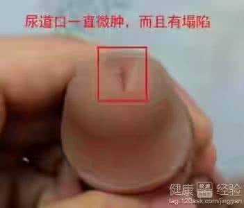 非淋菌性尿道炎 治疗非淋尿道炎 非淋性尿道炎 患上它要及时的治疗