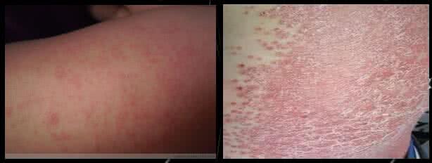 皮炎湿疹荨麻疹一扫光 图文:用双氧水、舒夫达湿疹顽癣一扫光!