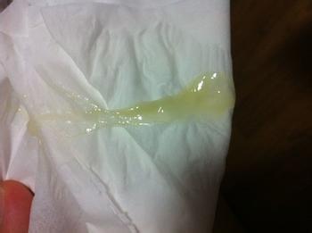 白带分泌物增多 白带增多 分泌物真的“不干净”