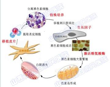 黑色素形成的原因 黑色素形成的原因 影响白癜风黑色素形成的原因