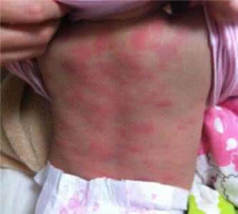 外国av 妈妈和女儿 这个外国妈妈为湿疹3年的女儿绝望时,中国的一条小偏方救了她