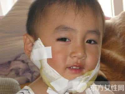 小儿腮腺炎 小儿腮腺炎（秘方数：5）