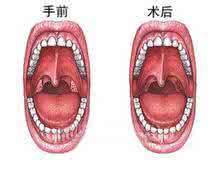 白喉症状怎么治疗方法 咽白喉 咽白喉的治疗与预防方法